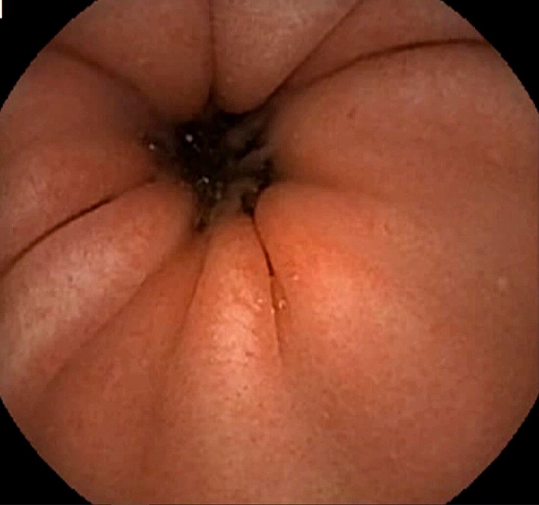 Healthy gastric antrum, endoscope view