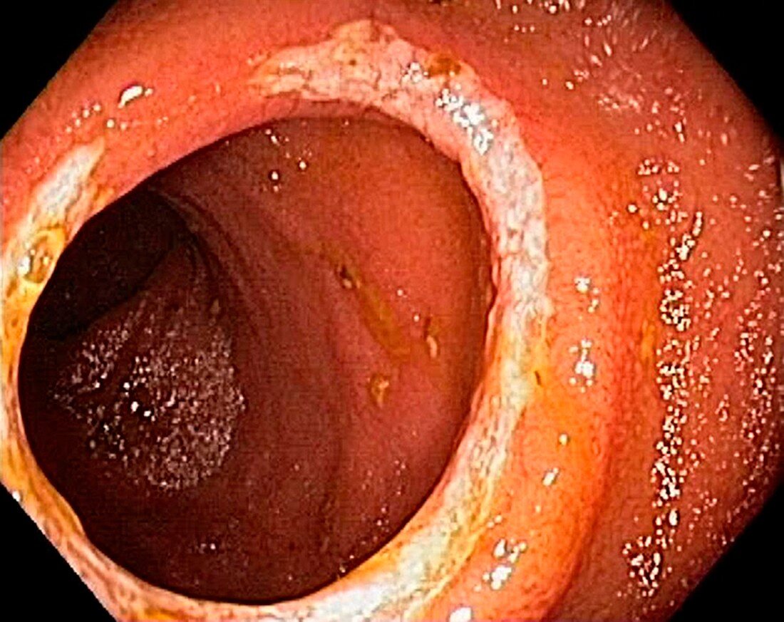 Crohn's disease in the ileum, endoscopic view
