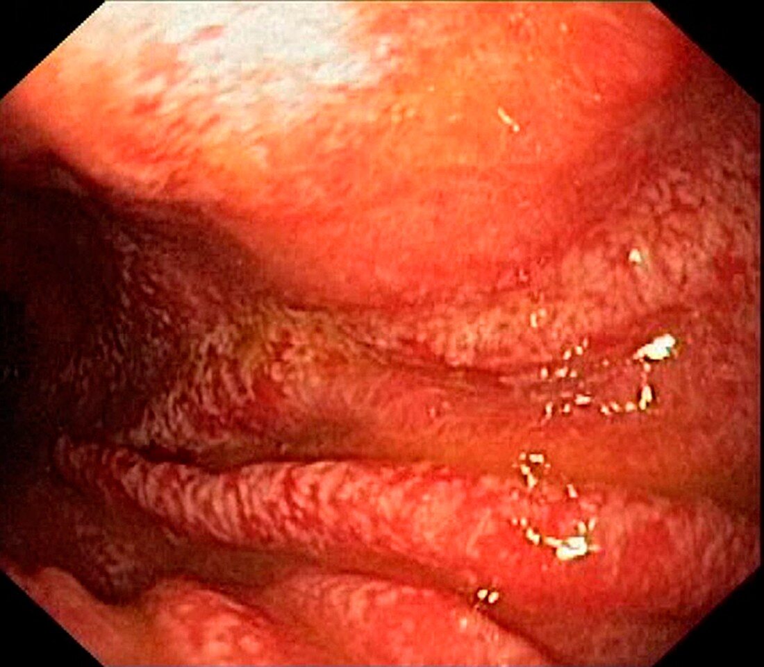 Intestinal metaplasia of the stomach, endoscopic view