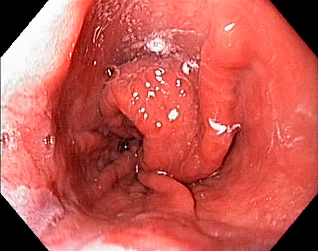 Gastro-oesophageal prolapse in hernia, endoscope view