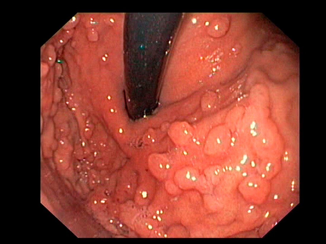 Hyperplastic polyps in the stomach, endoscopic view