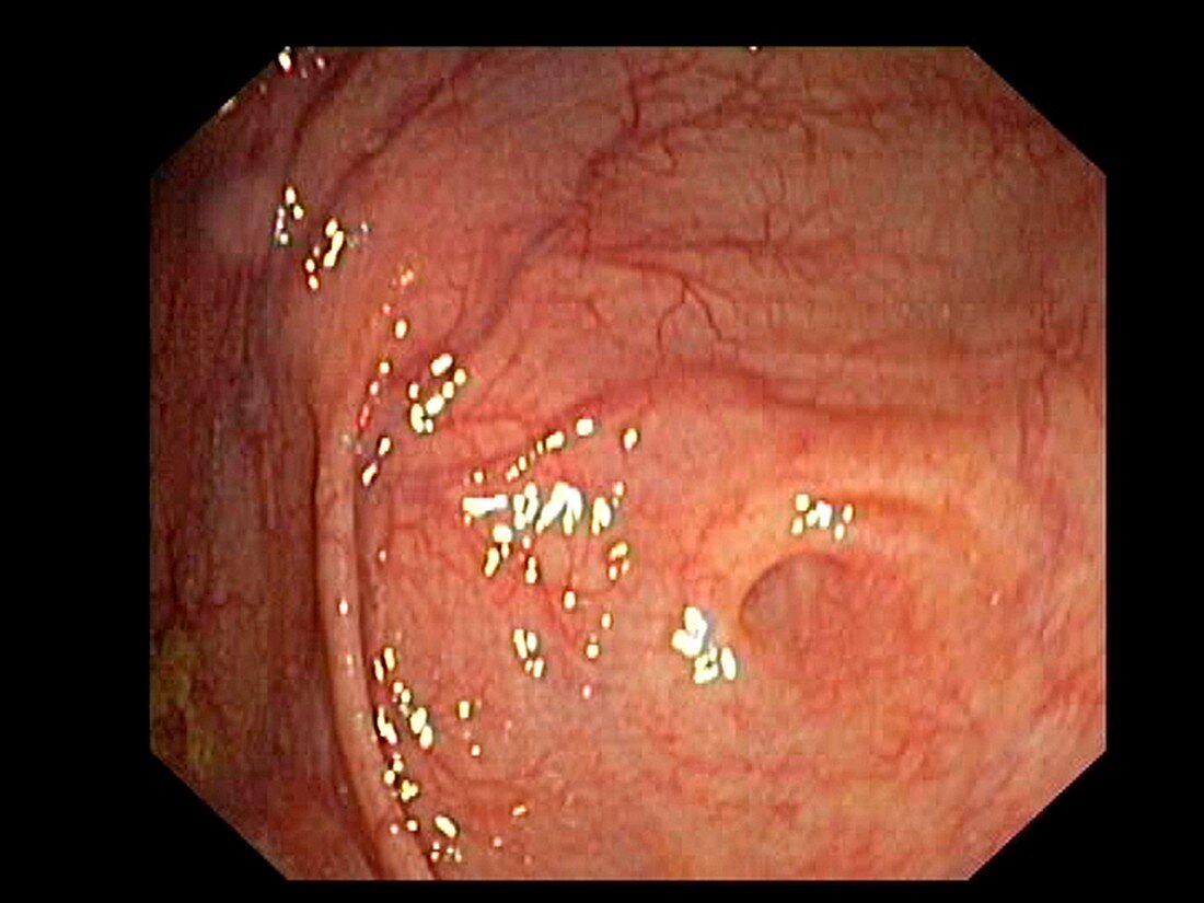 Caecum-appendix aperture, endoscopic view