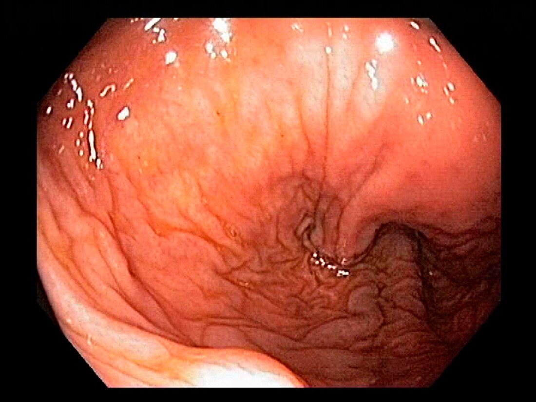 Healthy rectum, endoscope view