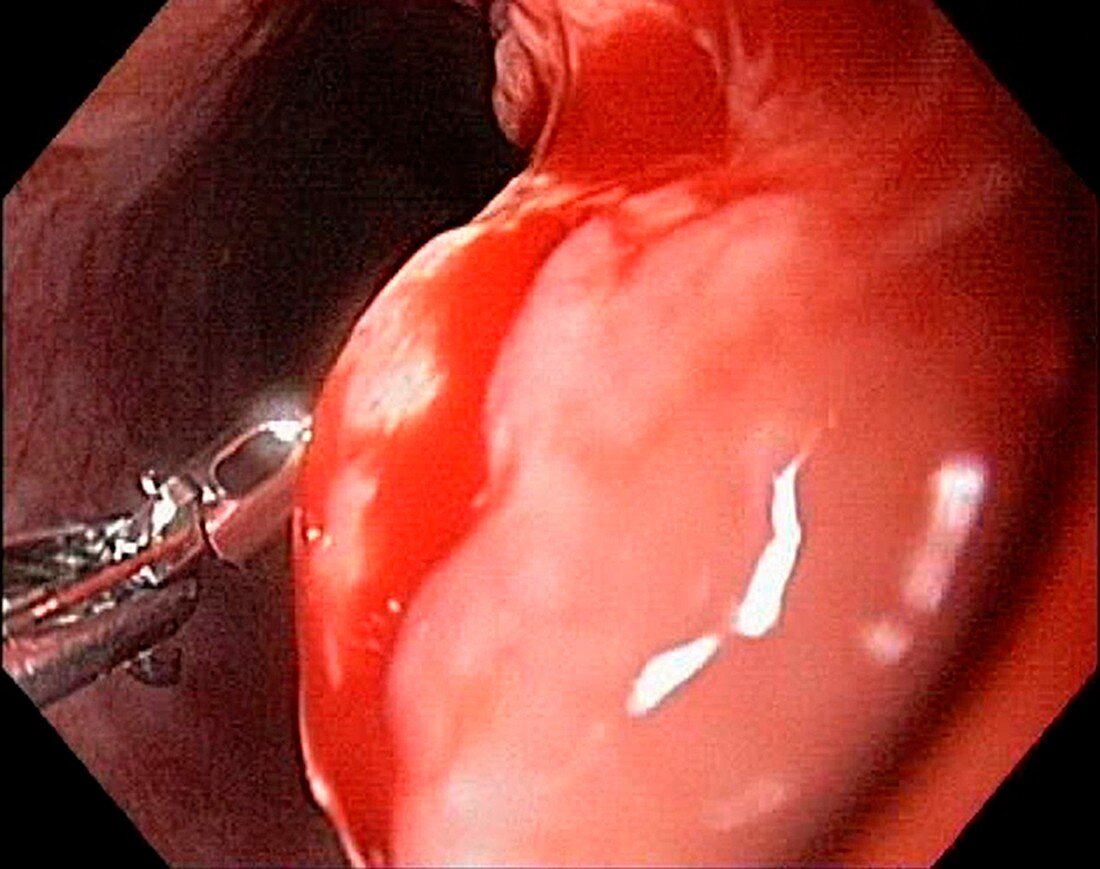 Oesophageal cancer, endoscope view