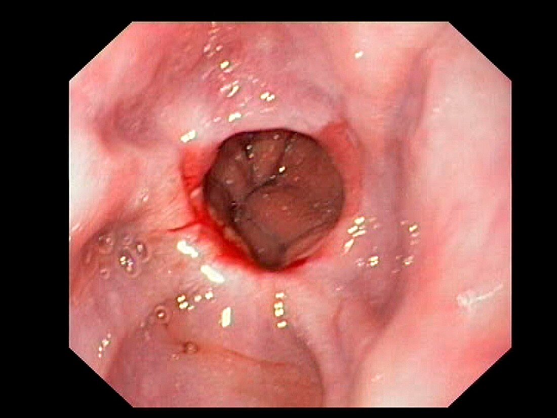 Oesophageal narrowing, endoscopic view