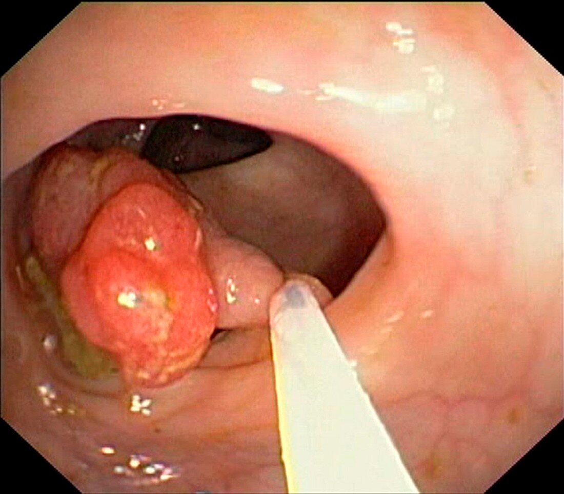 Colonic polypectomy, endoscope view