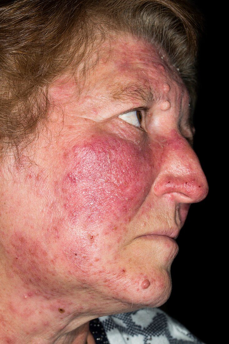 Acne rosacea