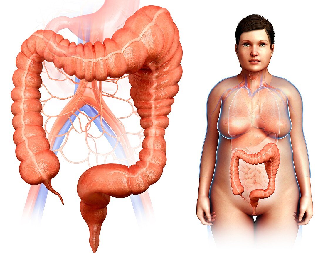 Mega colon, illustration