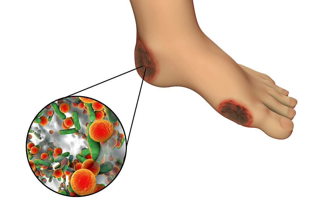 Destruction of Cytomegalovirus, illustration