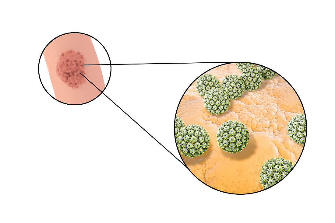Penile warts and human papilloma virus, illustration