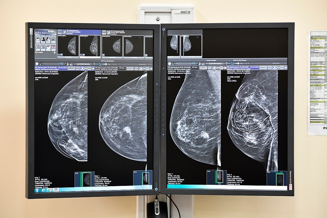 Mammograms for breast cancer surgery
