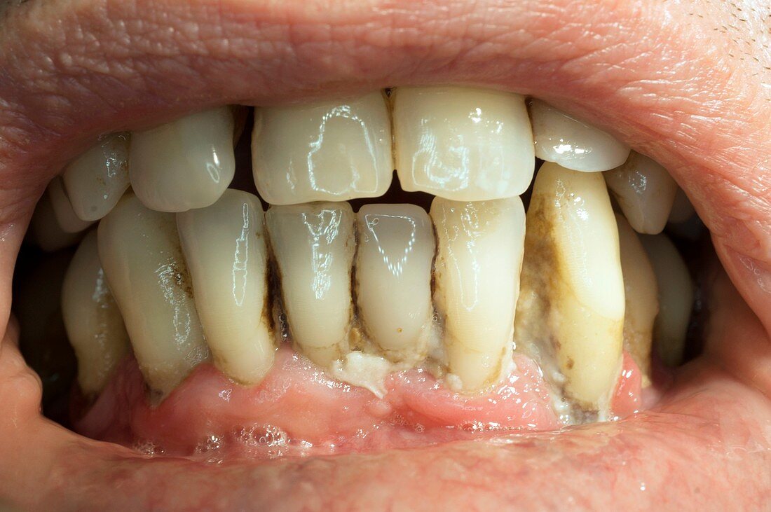 Teeth covered with plaque and tartar