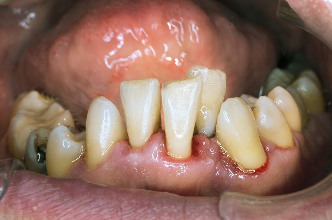 Teeth after ultrasonic cleaning
