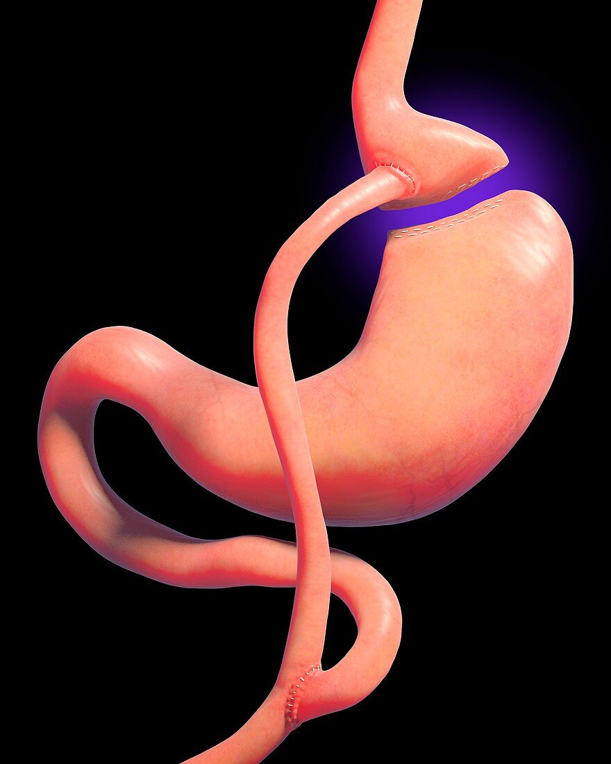 Gastric bypass surgery, illustration