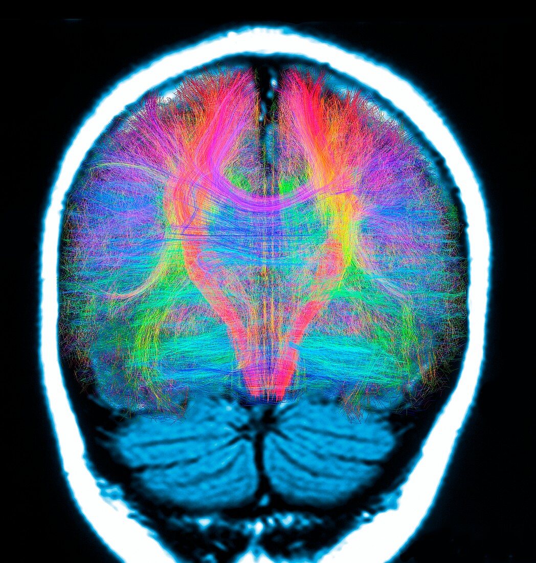 Brain MRI and white matter fibres