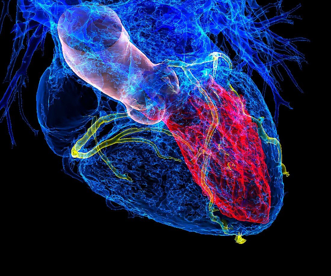 Heart in coronary artery disease, 3D CT scan
