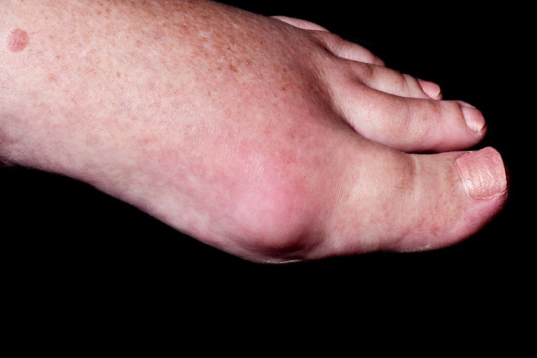 Swollen foot in gout