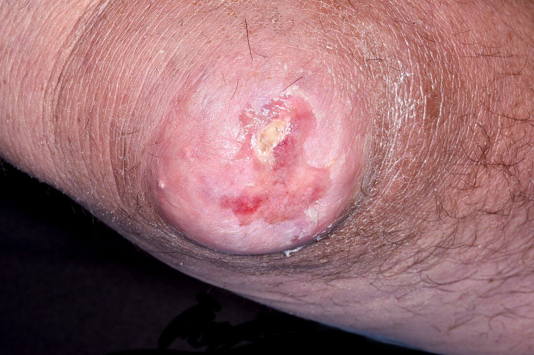 Ruptured tophus in gout