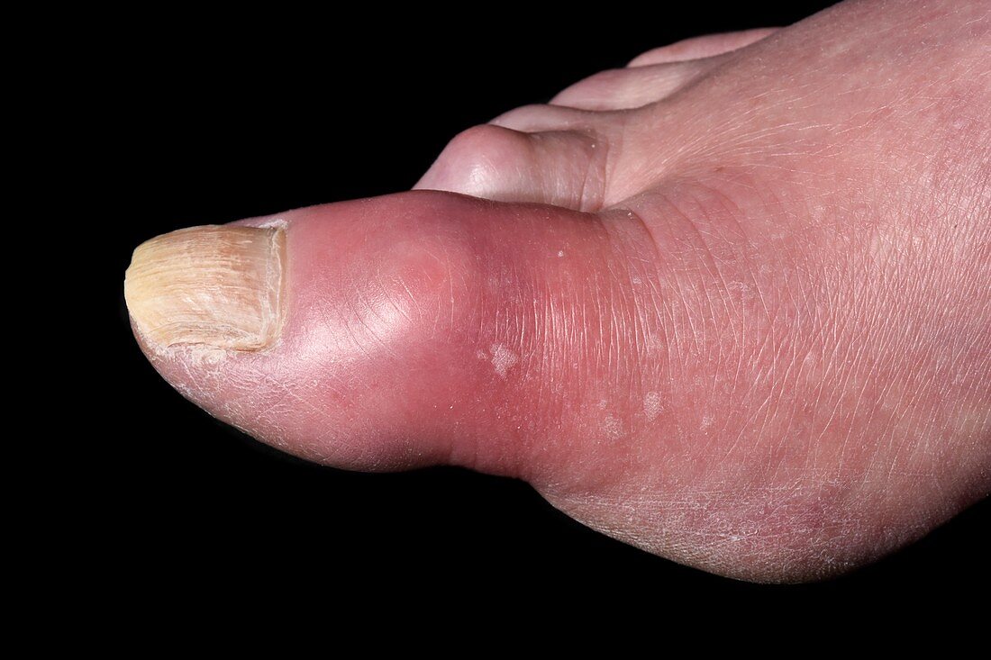 Swollen foot in gout
