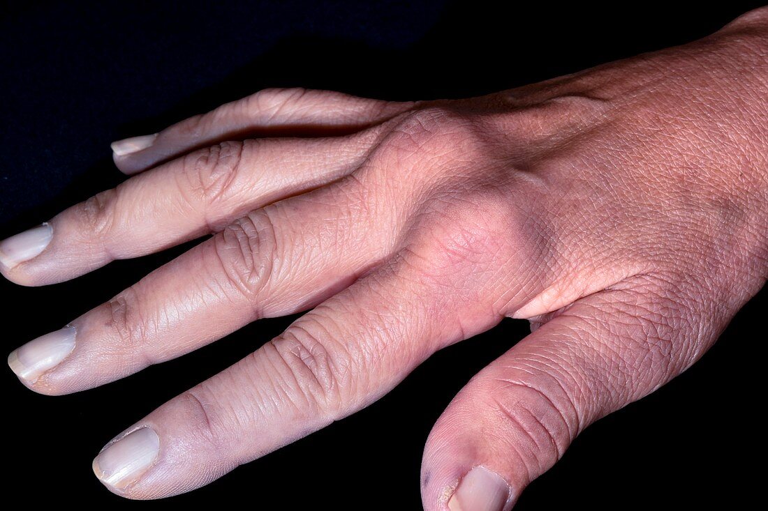 Hand in CREST syndrome