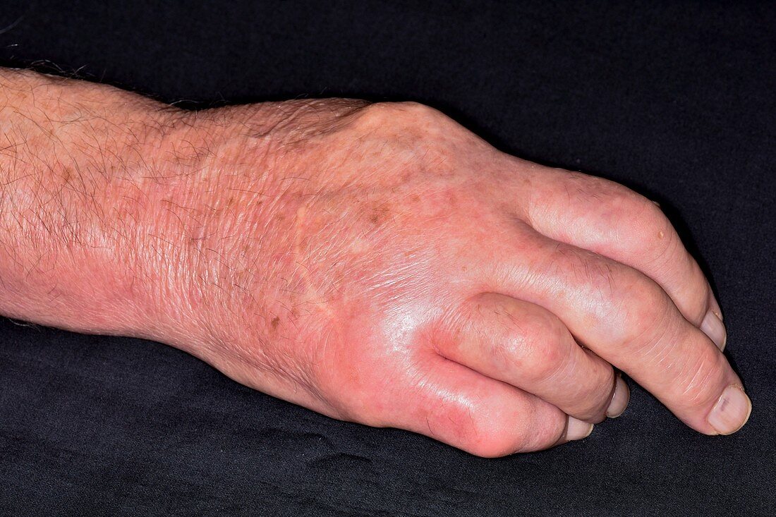 Swollen hand in gout