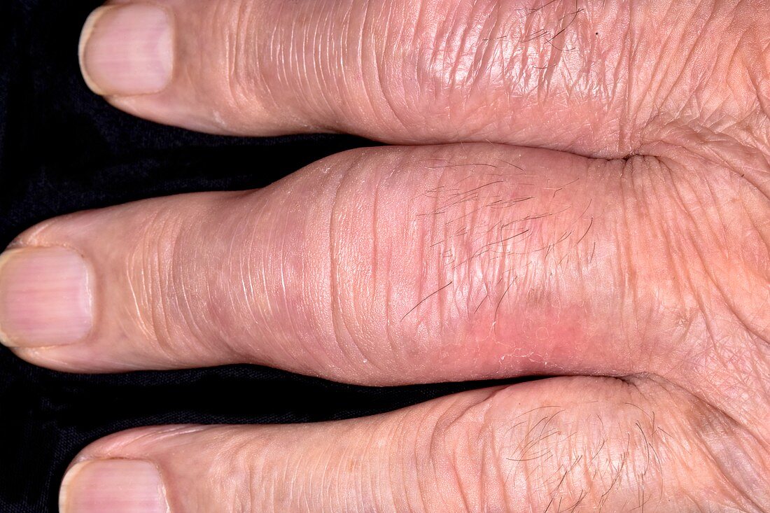 Fingers in osteoarthritis