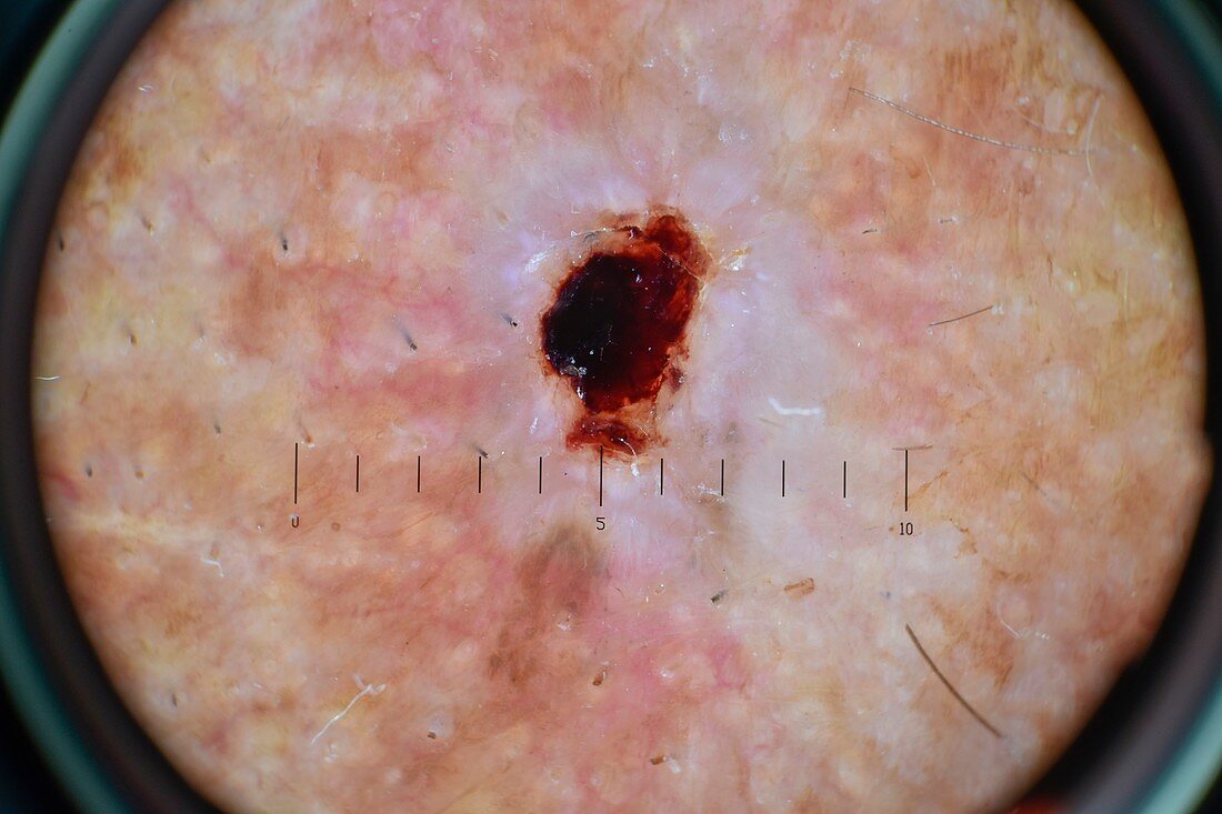 Basal cell carcinoma skin cancer, dermatoscopy