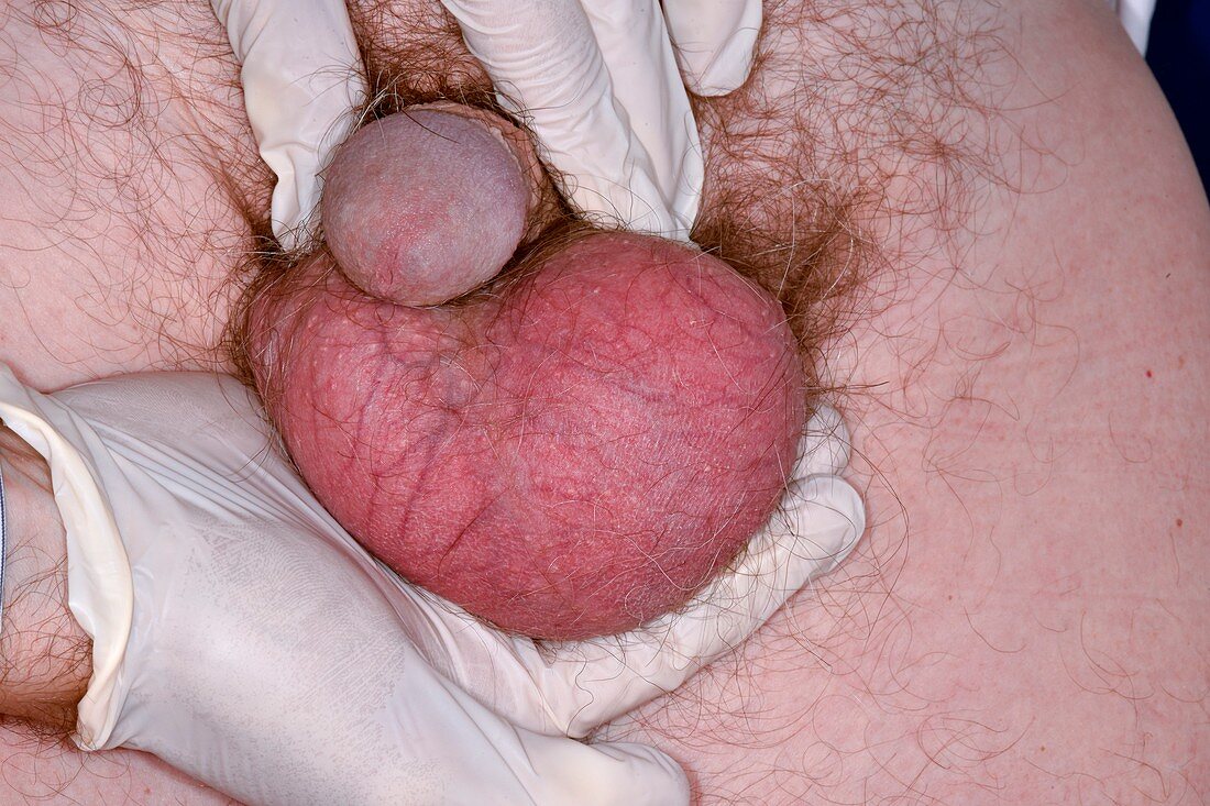 Testicular cancer