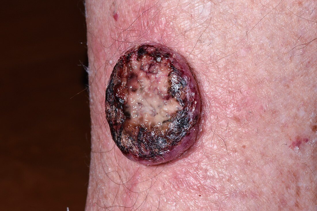Squamous cell carcinoma skin cancer