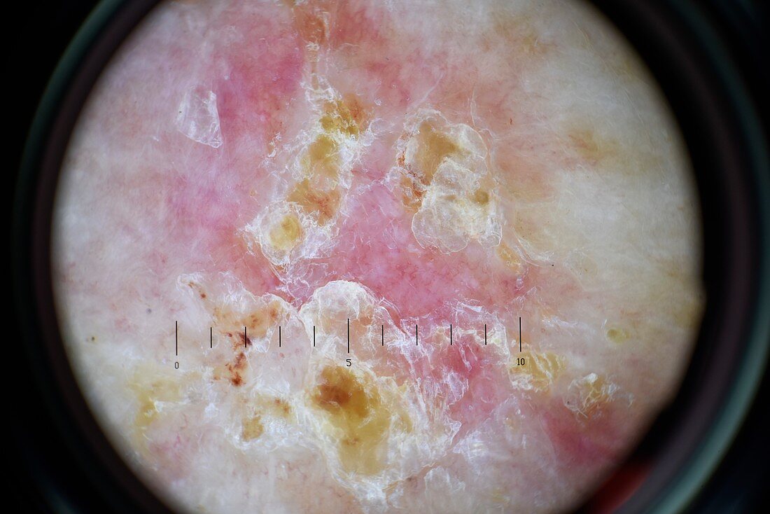 Basal cell carcinoma skin cancer, dermoscopy image