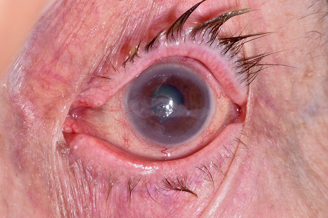 Eye disease following shingles infection