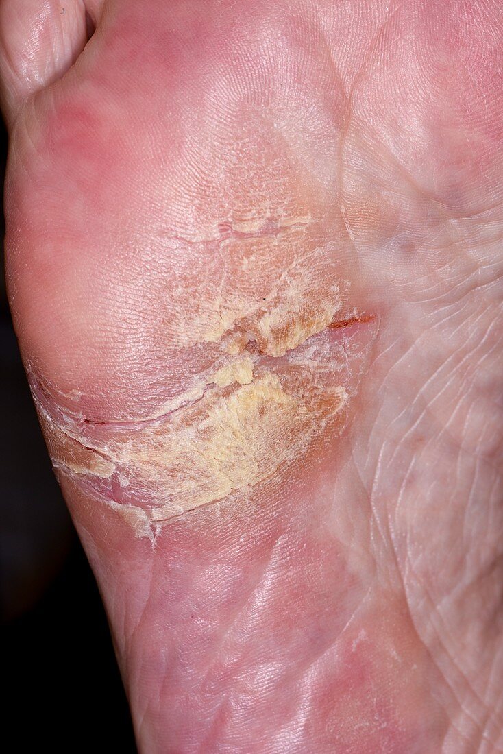 Psoriasis