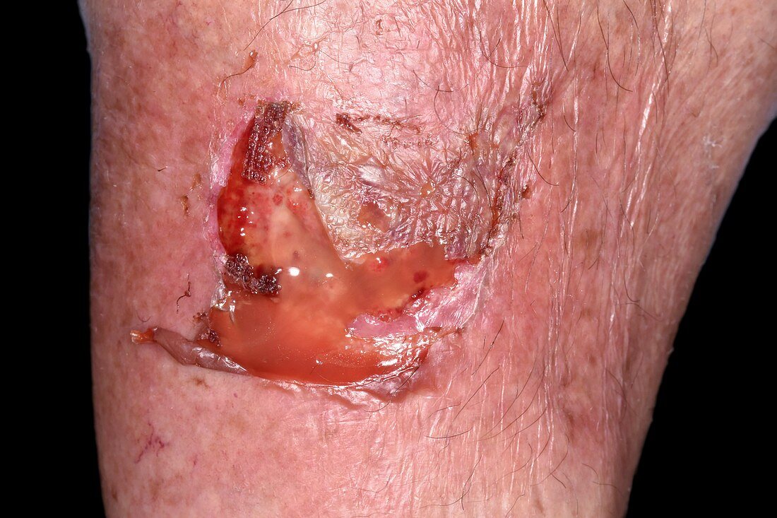 Infected leg wound