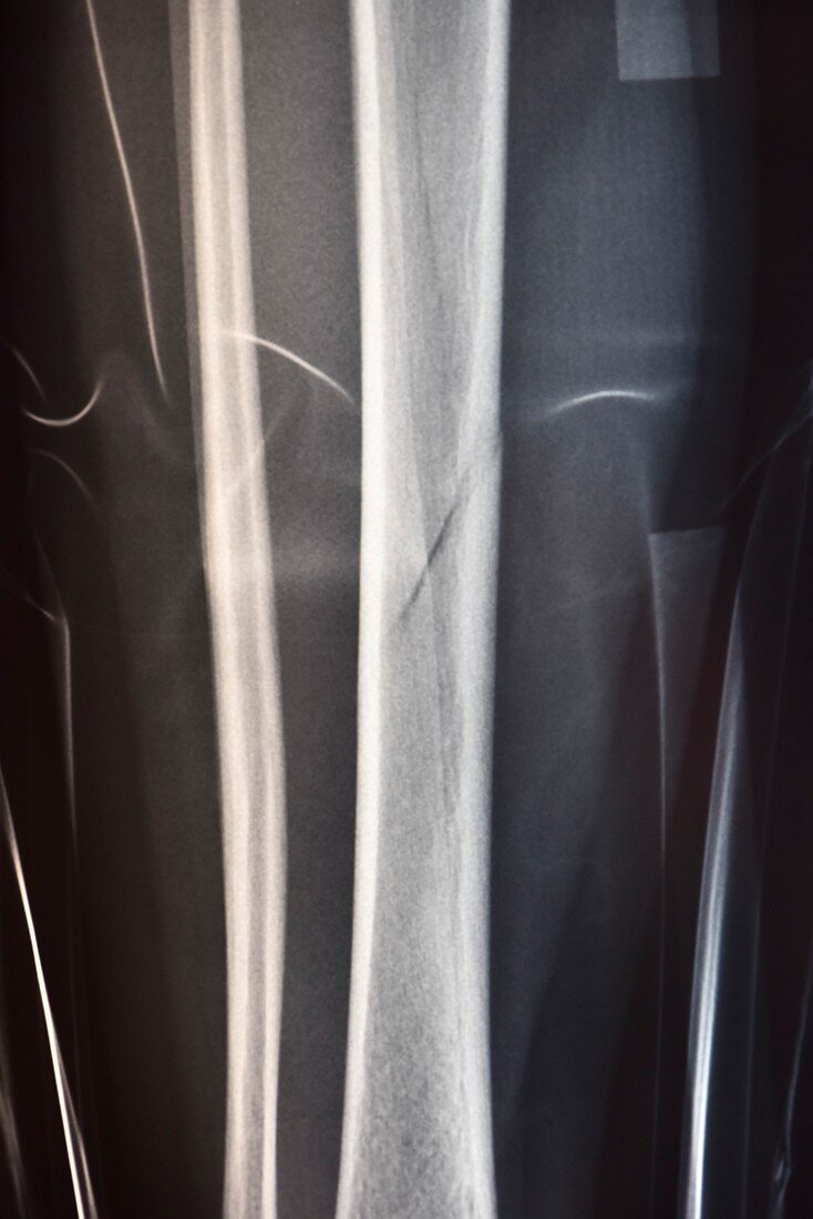 Fractured shin bone, X-ray