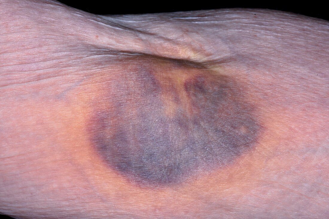 Venesection bruise in anticoagulant patient