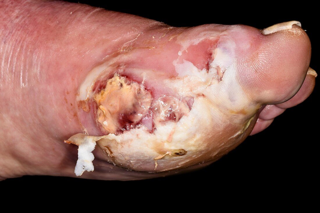 Infected foot ulcer