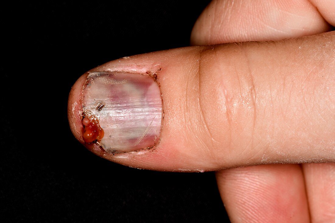 Infected thumb injury