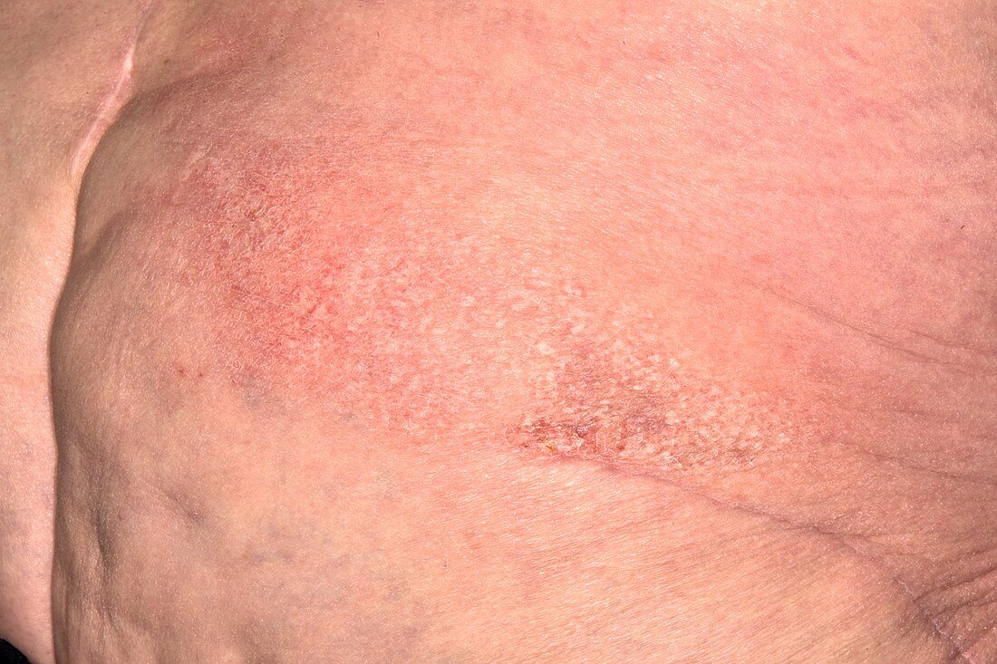 Dermatitis following shingles infection