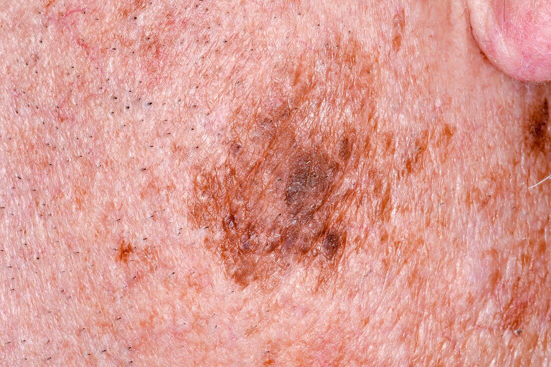 Hutchinsons lentigo skin cancer