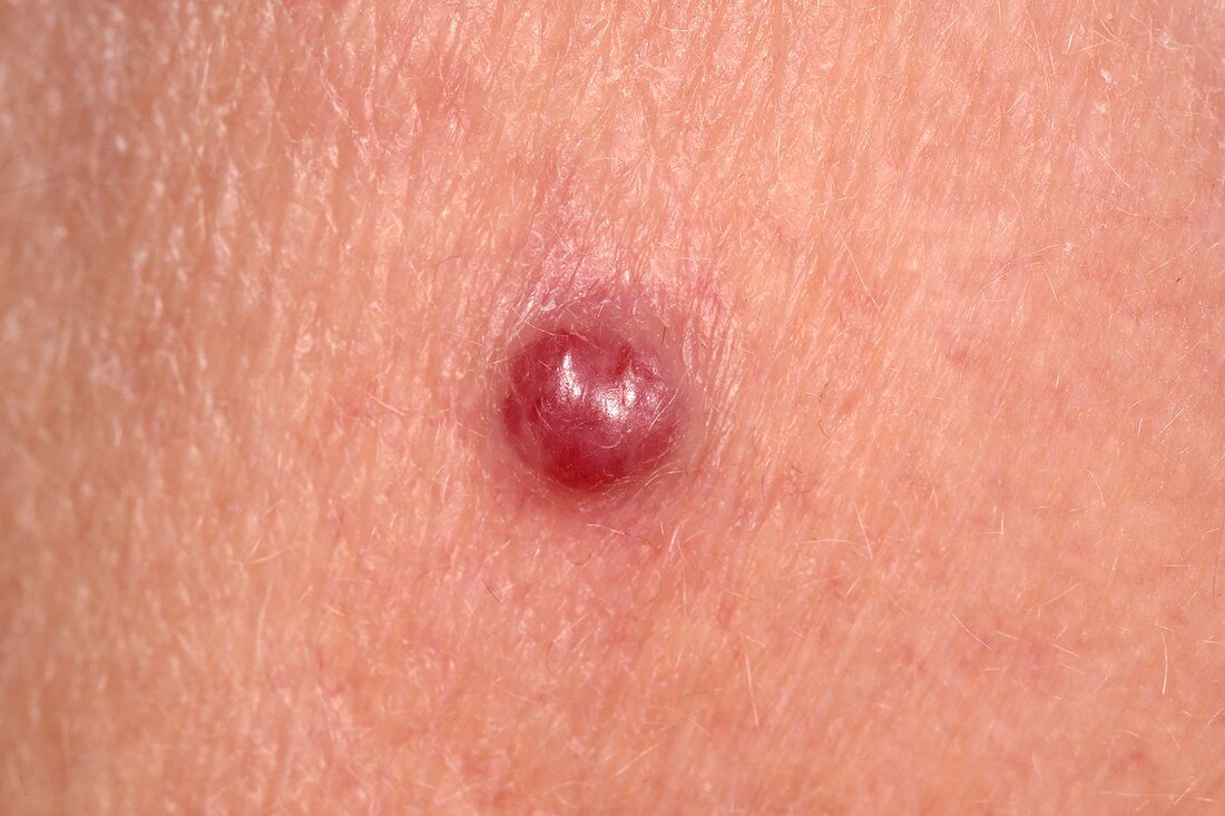 Capillary haemangioma