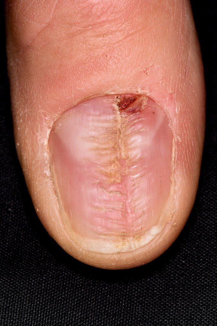 Ridged fingernail