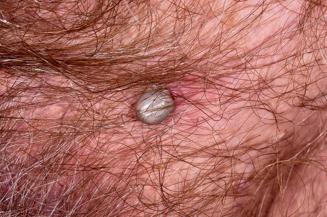 Tick on scrotum