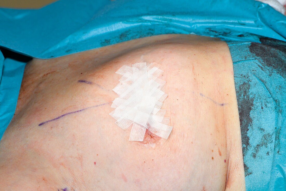 Taped wound after breast cancer surgery