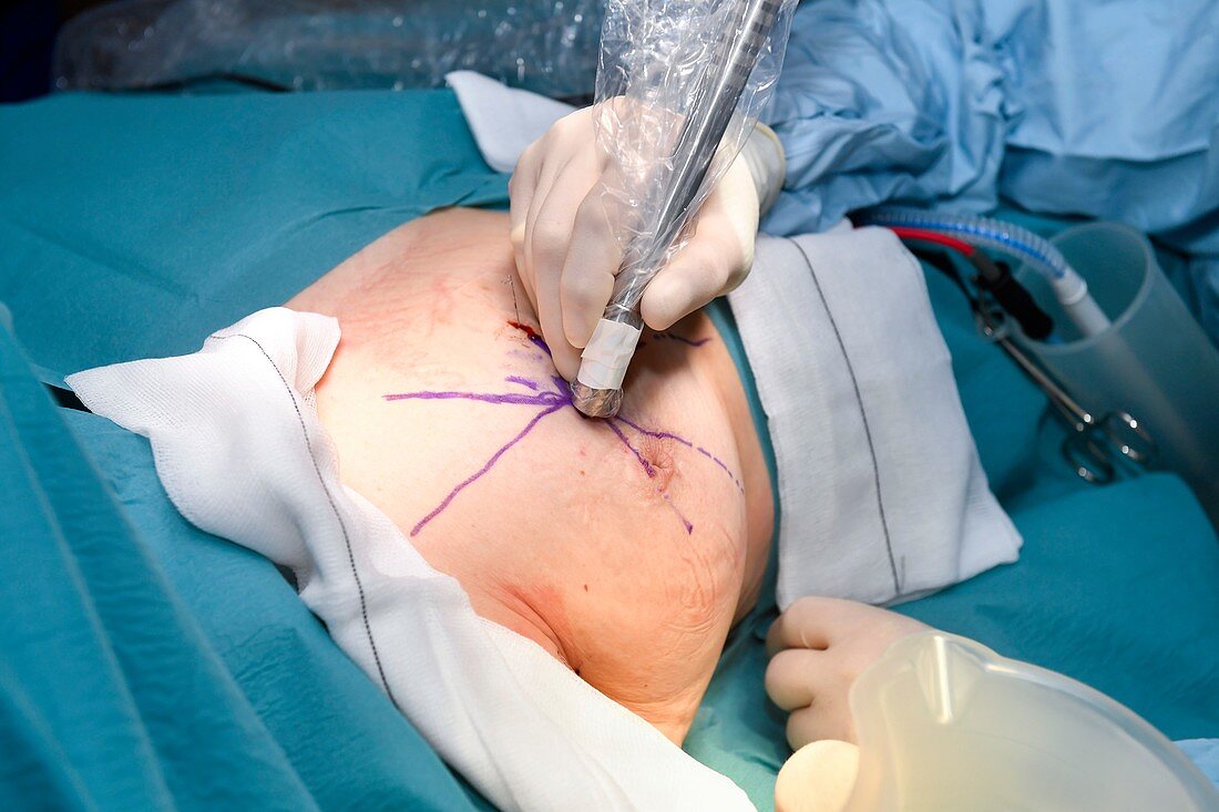 Breast cancer surgery using gamma camera