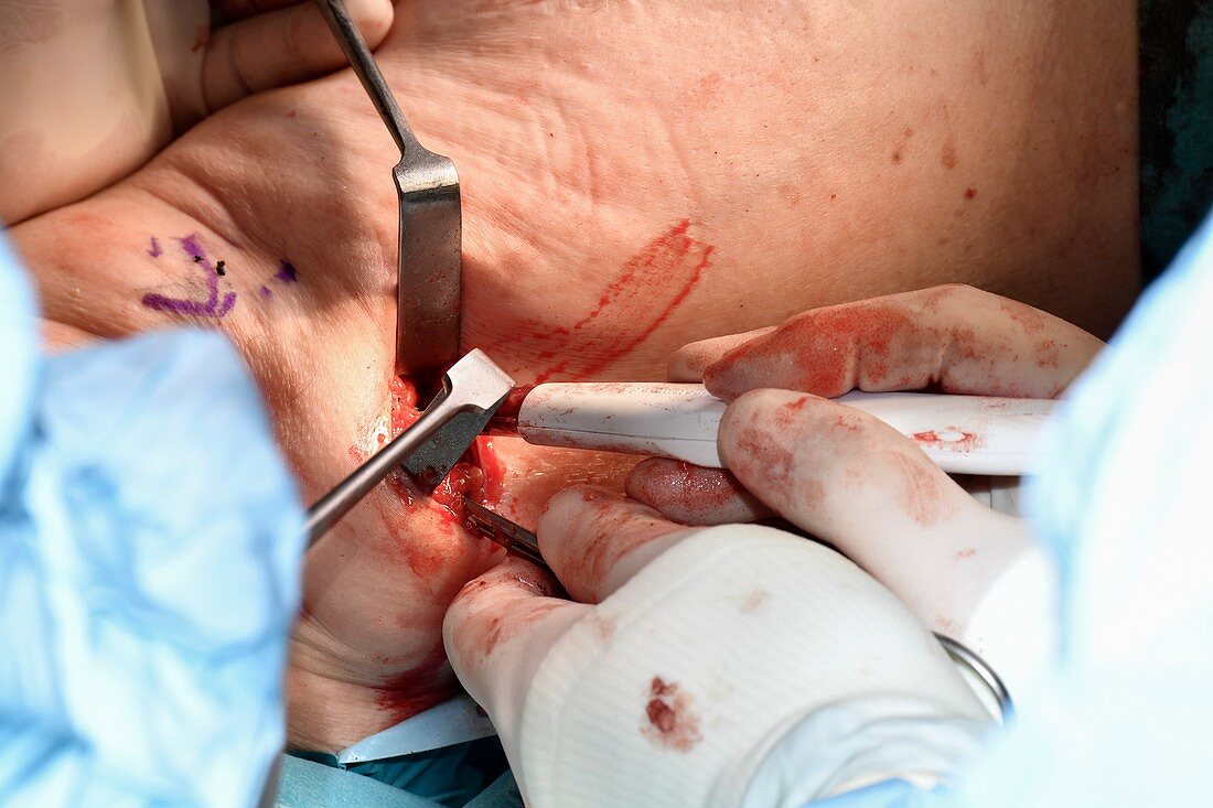 Tumour excision in breast cancer surgery