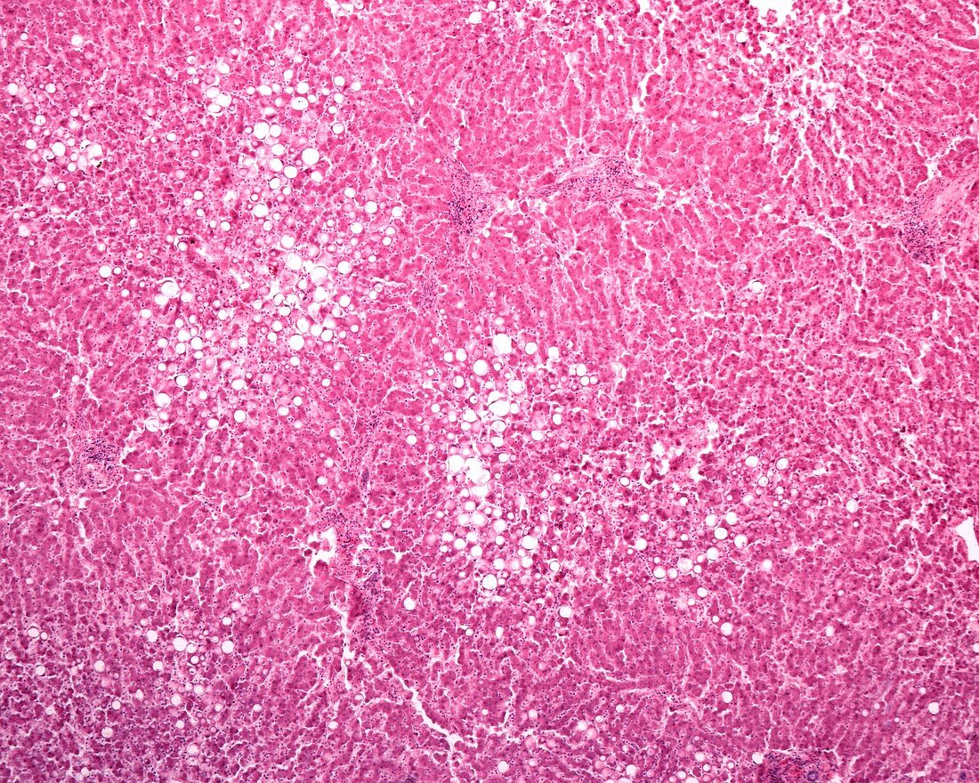 Fatty liver, light micrograph