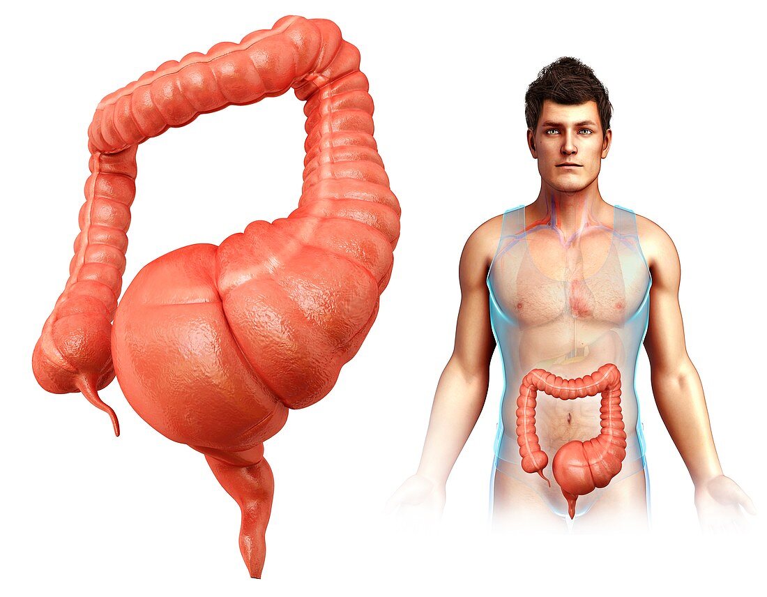 Man with mega colon, illustration