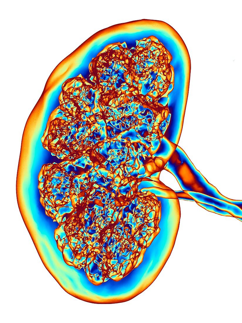 Kidney CT scan