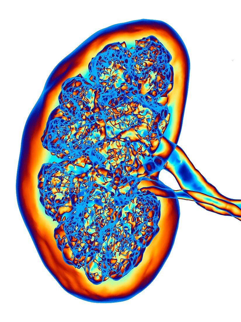 Kidney CT scan