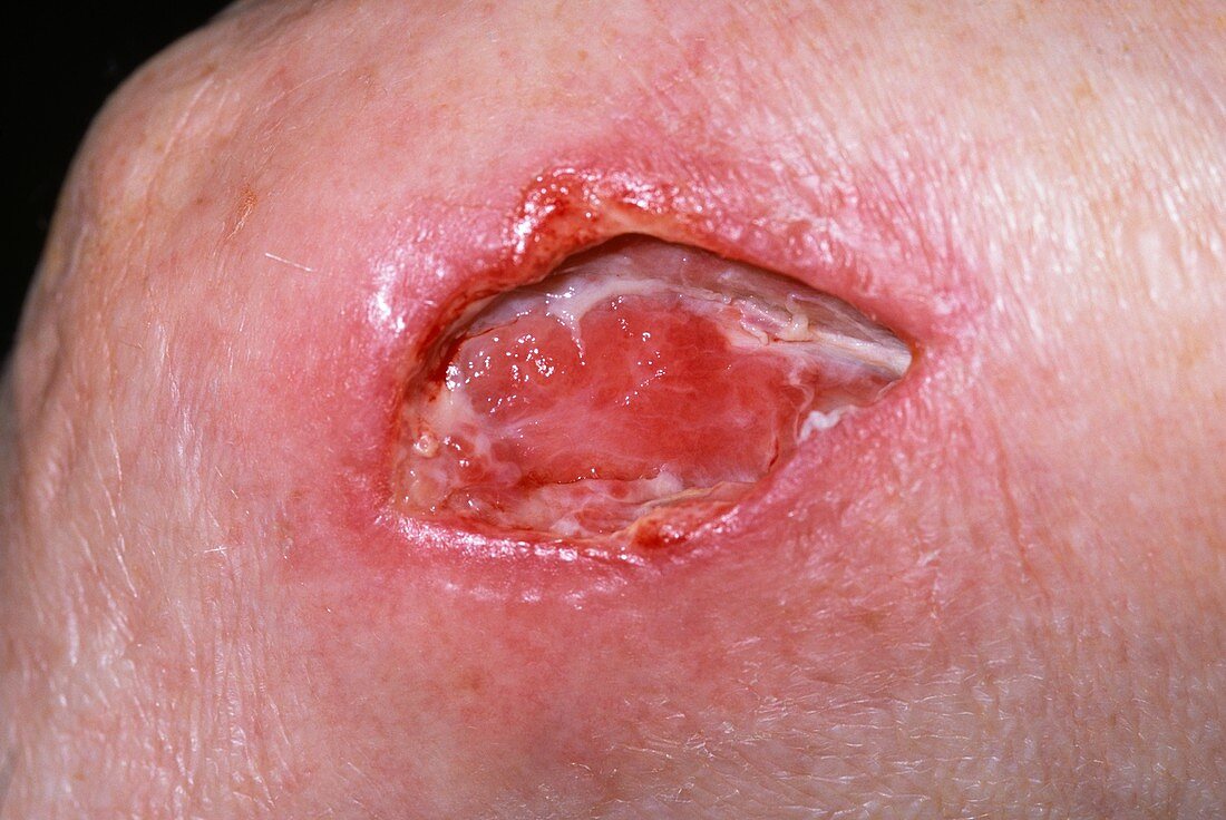 Elbow abscess